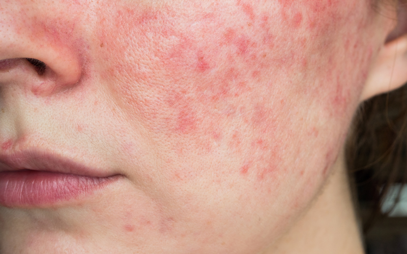 Rosacea/ Sensitive