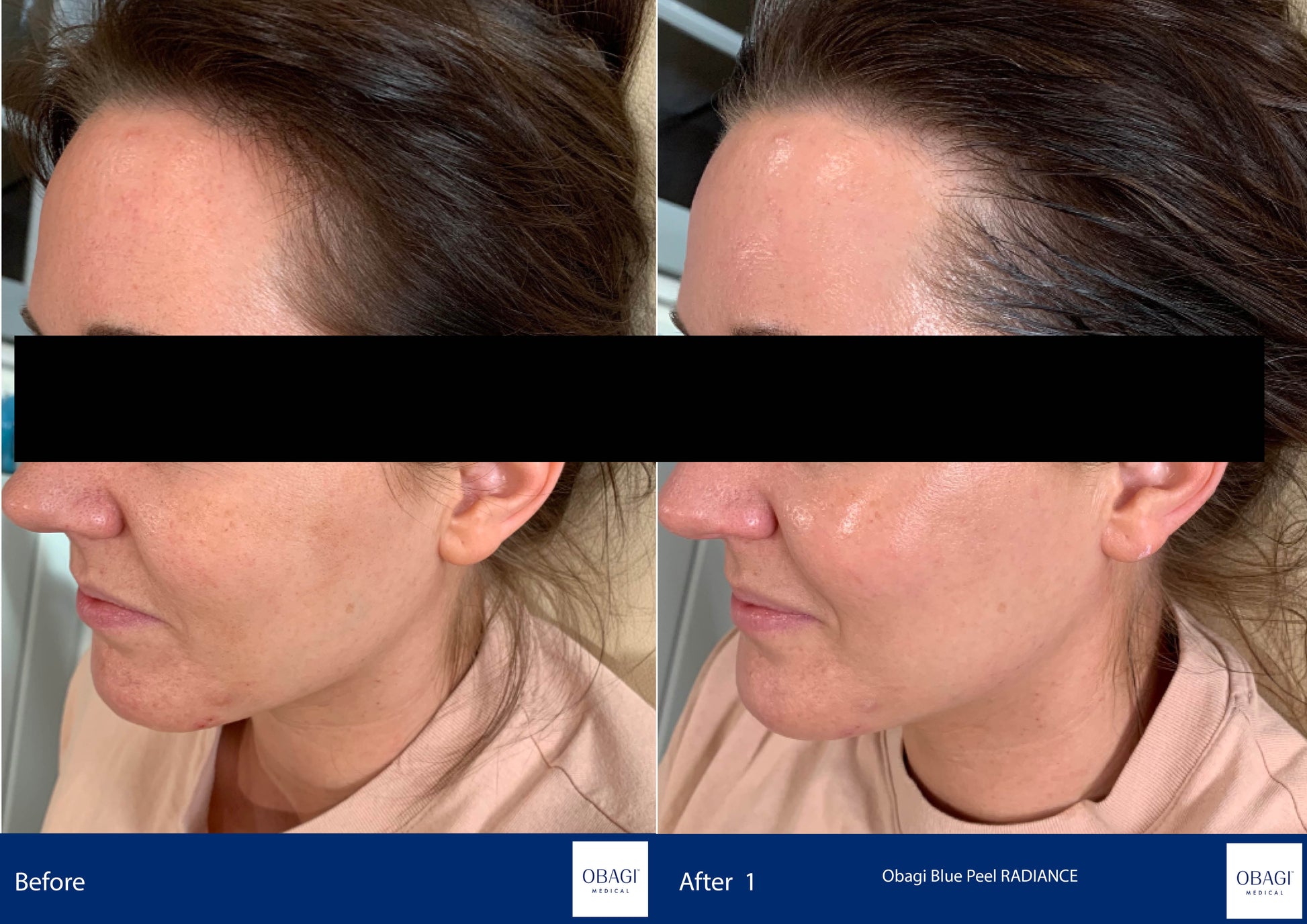 Before and after comparison of a woman's face with Obagi Blue Peel RADIANCE treatment.