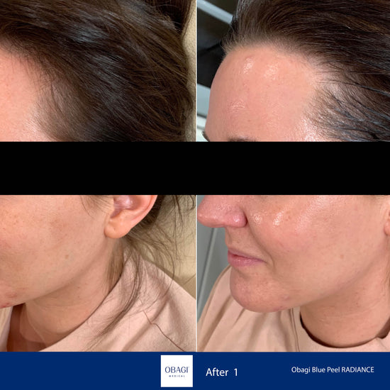 Before and after comparison of a woman's face with Obagi Blue Peel RADIANCE treatment.