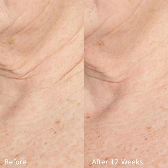Before and after comparison of skin texture with 'Before' on the left and 'After 12 Weeks' on the right.