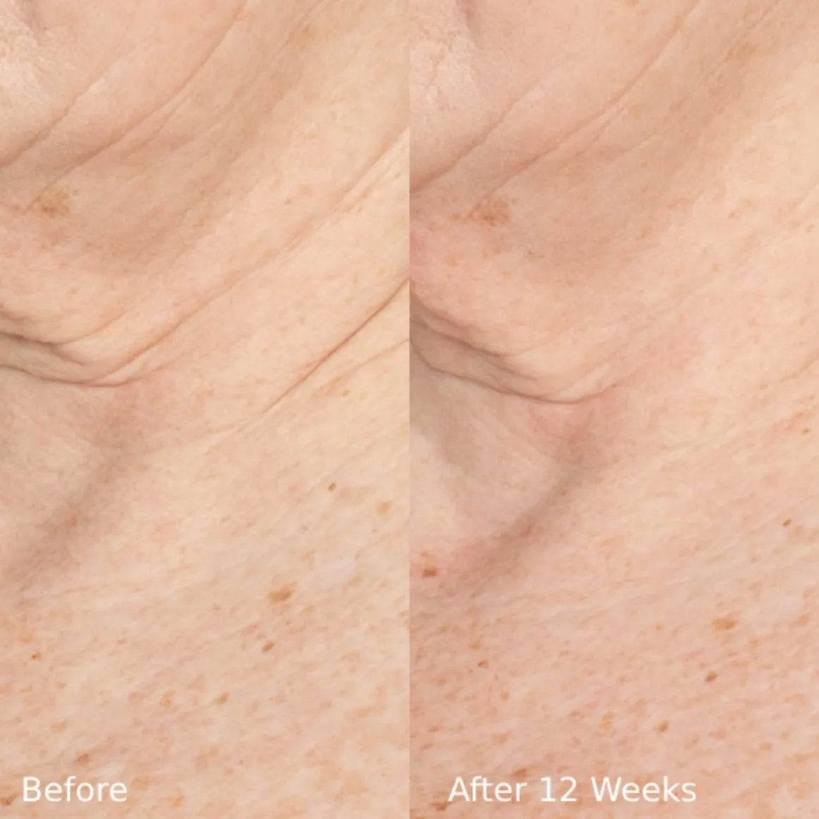 Before and after comparison of skin texture with 'Before' on the left and 'After 12 Weeks' on the right.