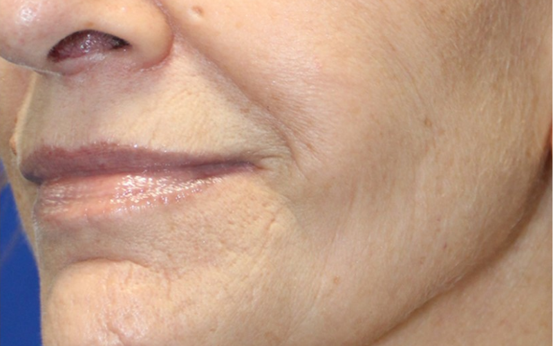 Close-up of a person's chin and neck with visiblly reduced lines.
