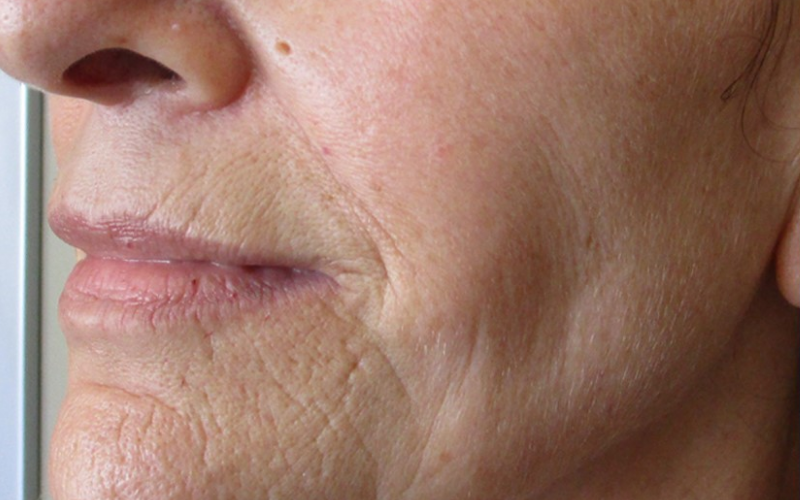 Close-up of a person's face showing signs of aging on the skin.