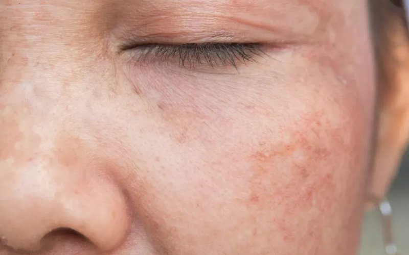 Sun Damage/ Pigmentation